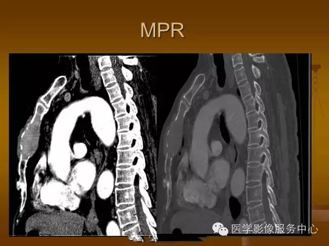 【病例】胸骨浆细胞骨髓瘤1例CT影像表现
