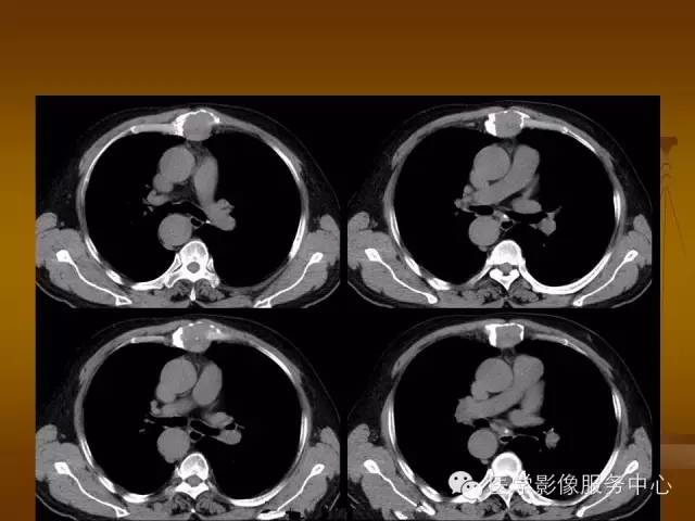 【病例】胸骨浆细胞骨髓瘤1例CT影像表现