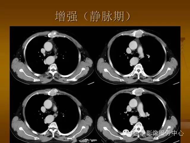 【病例】胸骨浆细胞骨髓瘤1例CT影像表现