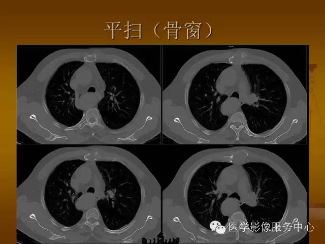 【病例】胸骨浆细胞骨髓瘤1例CT影像表现