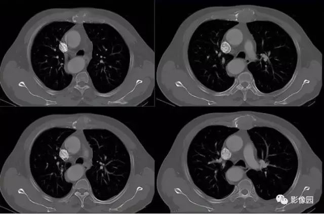 【病例】胸骨浆细胞骨髓瘤1例CT影像表现