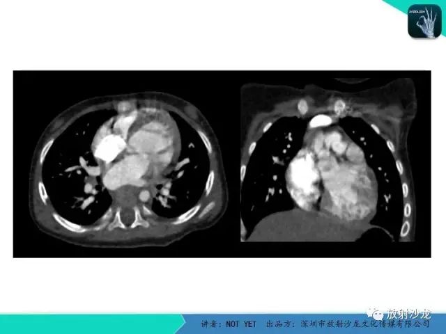 【病例】动脉导管未闭1例CT影像表现