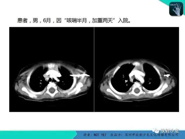 【病例】动脉导管未闭1例CT影像表现
