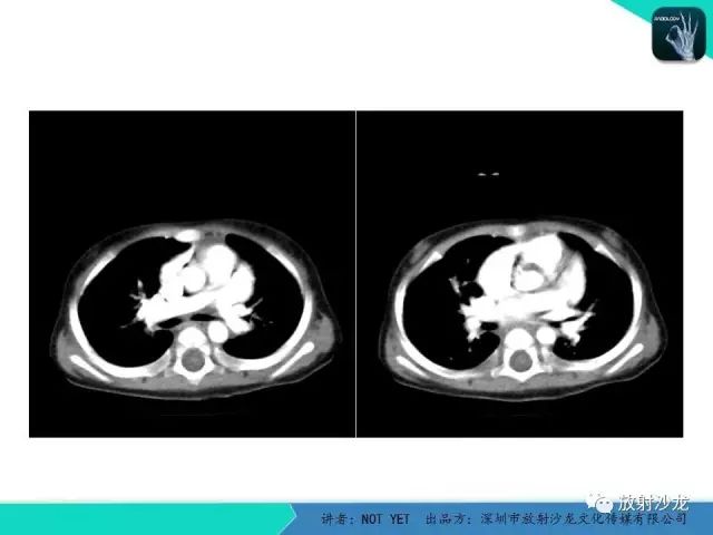 【病例】动脉导管未闭1例CT影像表现