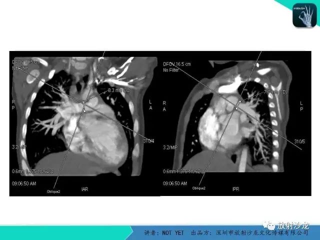 【病例】动脉导管未闭1例CT影像表现