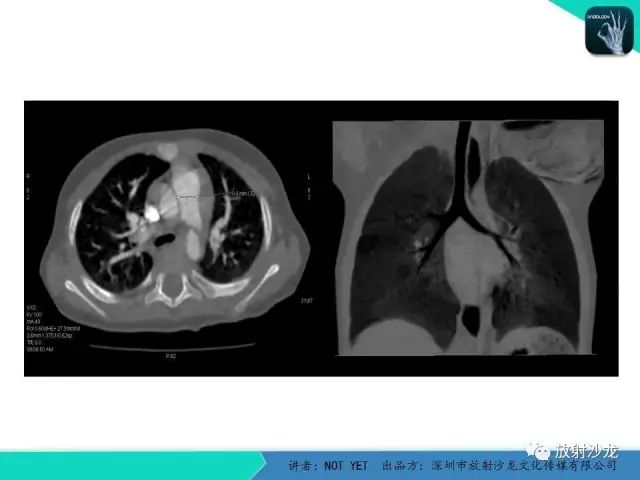 【病例】动脉导管未闭1例CT影像表现