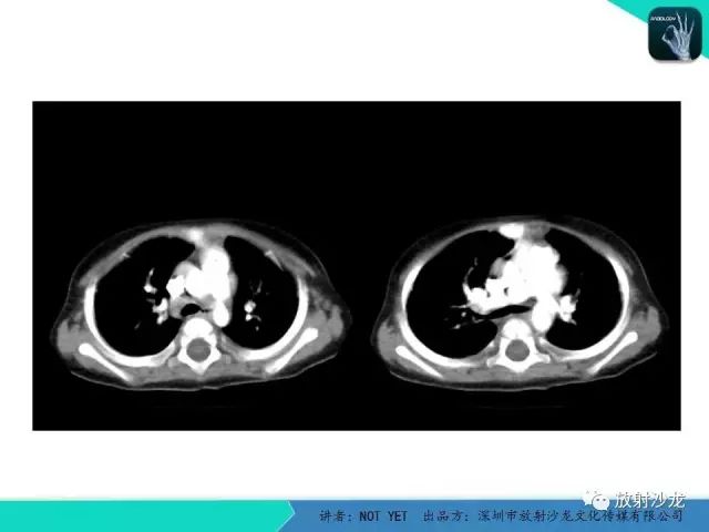 【病例】动脉导管未闭1例CT影像表现