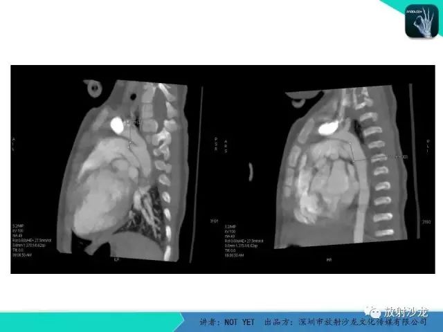 【病例】动脉导管未闭1例CT影像表现
