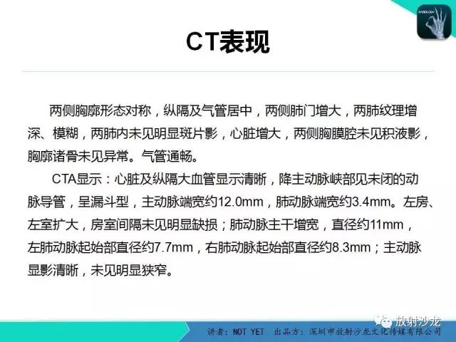 【病例】动脉导管未闭1例CT影像表现