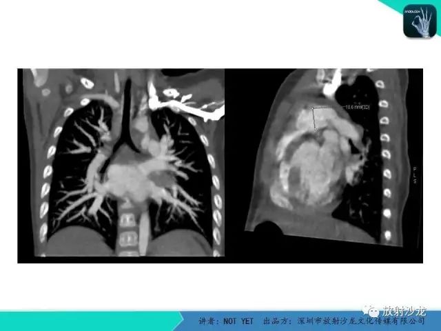 【病例】动脉导管未闭1例CT影像表现