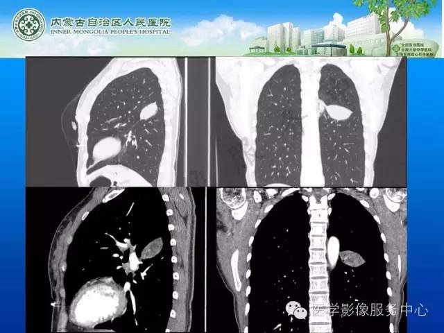 【病例】肺叶间血管淋巴管瘤1例CT