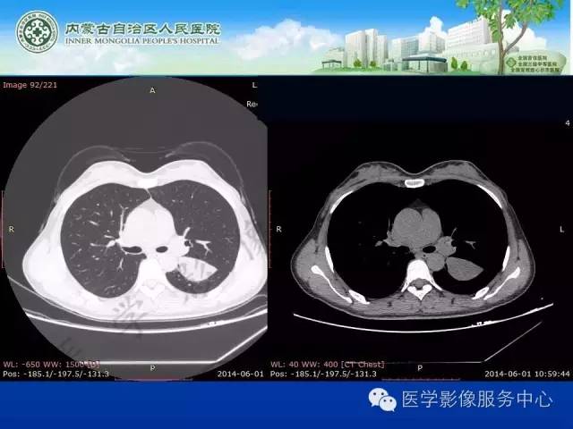【病例】肺叶间血管淋巴管瘤1例CT