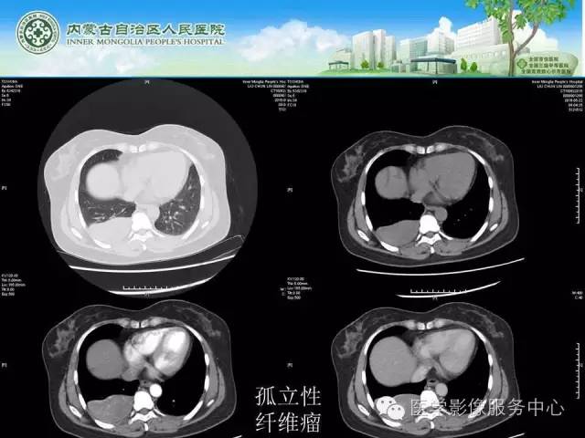 【病例】肺叶间血管淋巴管瘤1例CT