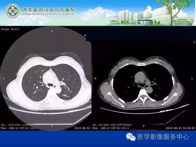 【病例】肺叶间血管淋巴管瘤1例CT