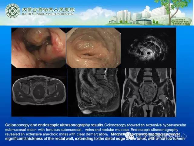 【病例】肺叶间血管淋巴管瘤1例CT