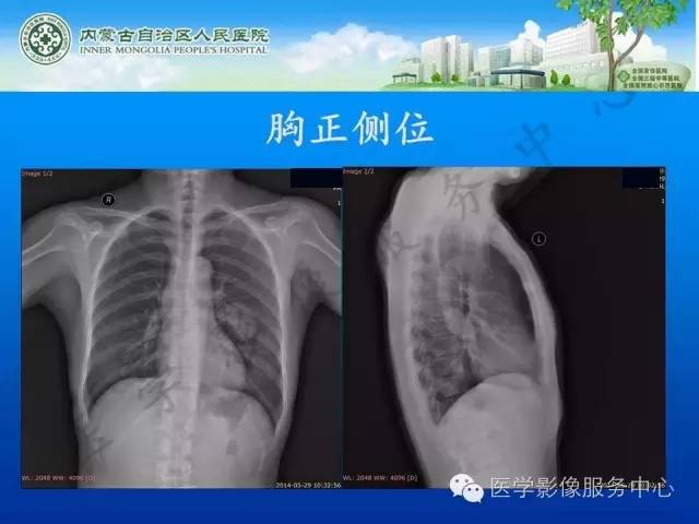 【病例】肺叶间血管淋巴管瘤1例CT