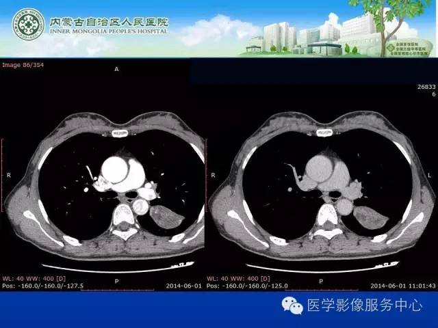 【病例】肺叶间血管淋巴管瘤1例CT