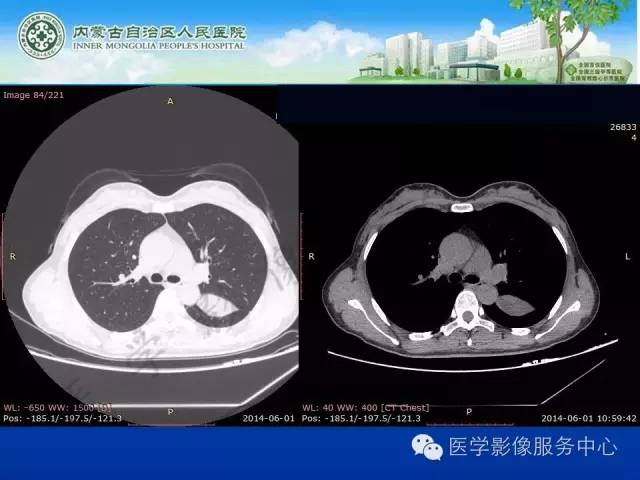 【病例】肺叶间血管淋巴管瘤1例CT