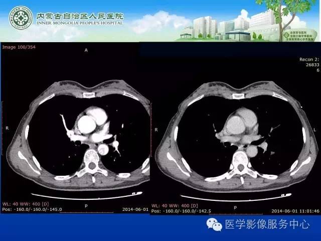 【病例】肺叶间血管淋巴管瘤1例CT