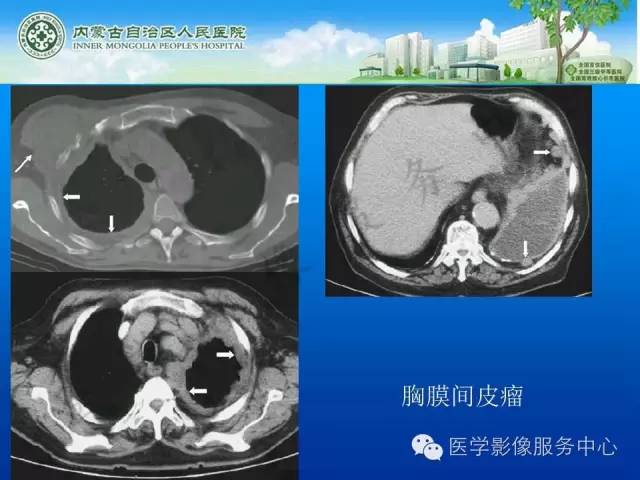 【病例】肺叶间血管淋巴管瘤1例CT