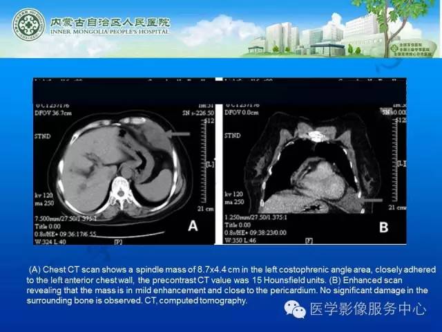 【病例】肺叶间血管淋巴管瘤1例CT