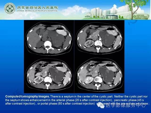 【病例】肺叶间血管淋巴管瘤1例CT