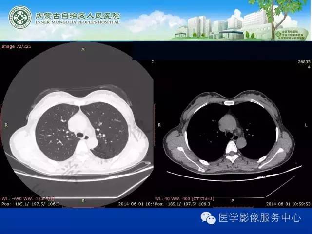 【病例】肺叶间血管淋巴管瘤1例CT