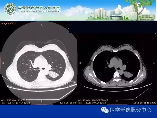 【病例】肺叶间血管淋巴管瘤1例CT
