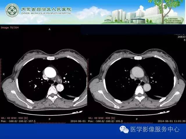 【病例】肺叶间血管淋巴管瘤1例CT