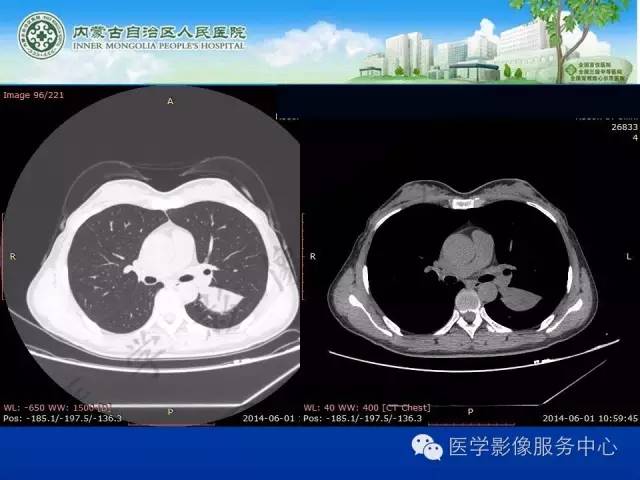 【病例】肺叶间血管淋巴管瘤1例CT