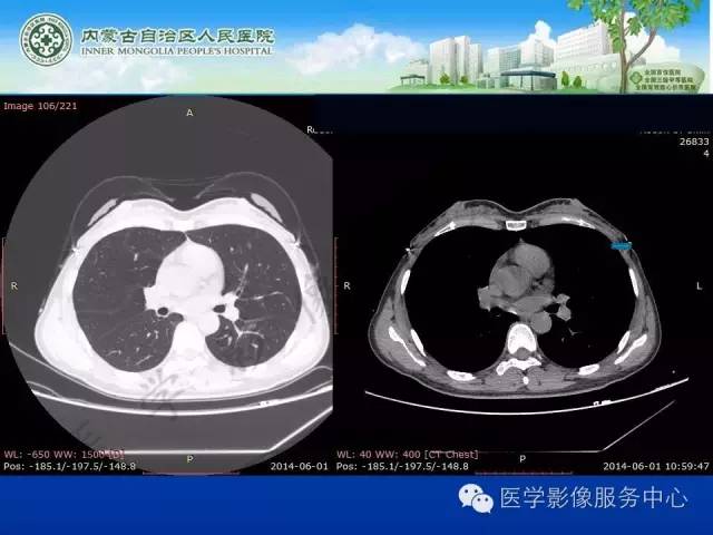 【病例】肺叶间血管淋巴管瘤1例CT