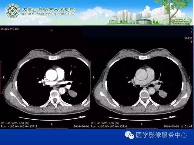 【病例】肺叶间血管淋巴管瘤1例CT