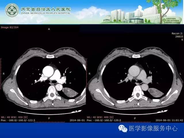 【病例】肺叶间血管淋巴管瘤1例CT