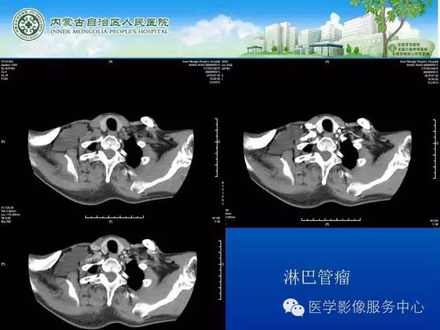 【病例】肺叶间血管淋巴管瘤1例CT