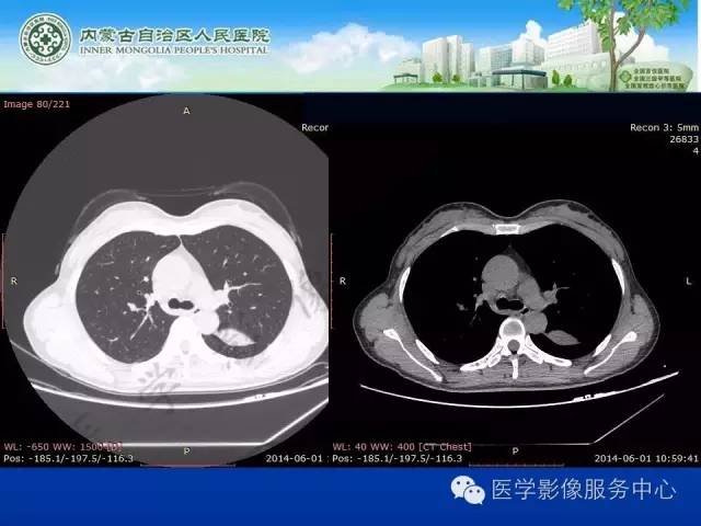 【病例】肺叶间血管淋巴管瘤1例CT