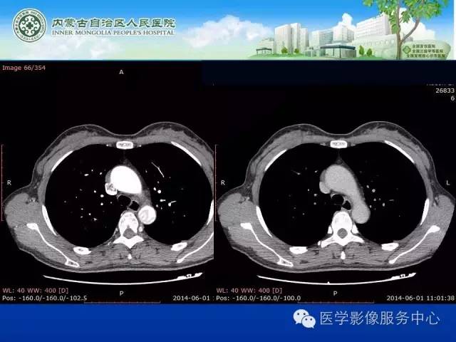 【病例】肺叶间血管淋巴管瘤1例CT