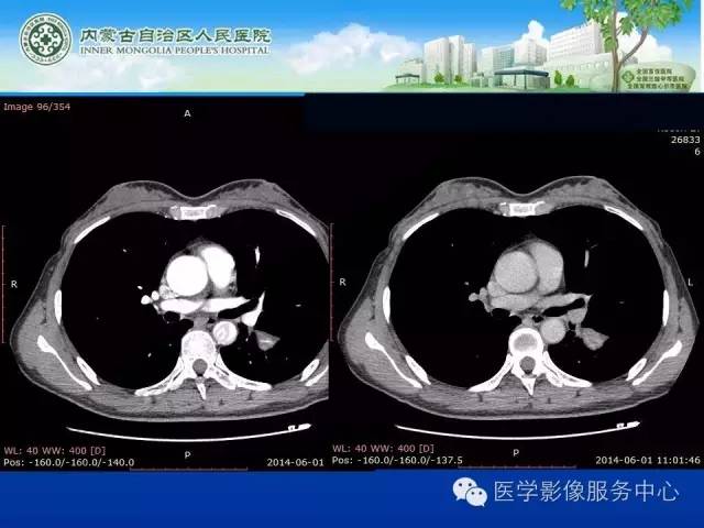 【病例】肺叶间血管淋巴管瘤1例CT