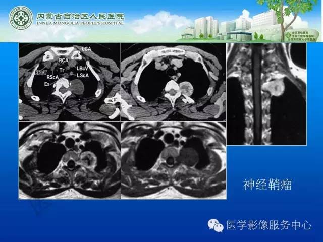 【病例】肺叶间血管淋巴管瘤1例CT
