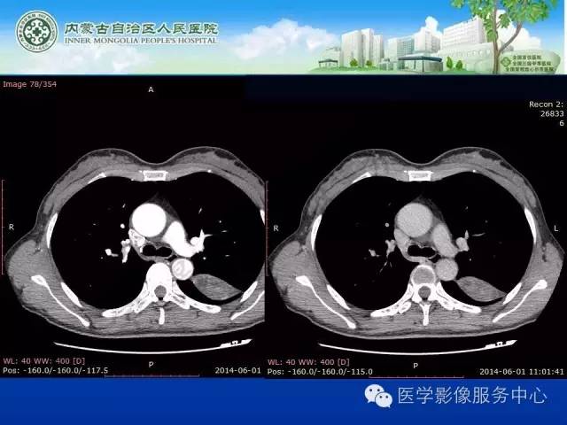 【病例】肺叶间血管淋巴管瘤1例CT