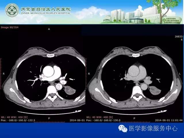 【病例】肺叶间血管淋巴管瘤1例CT