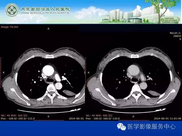 【病例】肺叶间血管淋巴管瘤1例CT