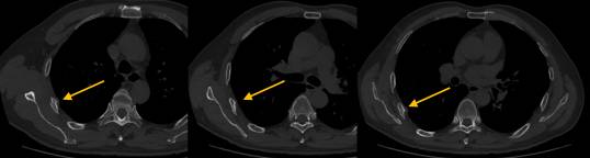 竟然是同一个患者？外伤肋骨骨折一定要建议复查！