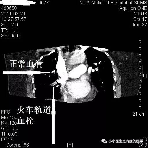 肺栓塞CT轻松入门