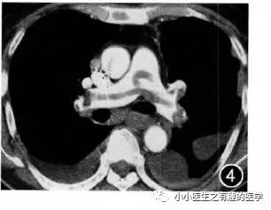 肺栓塞CT轻松入门