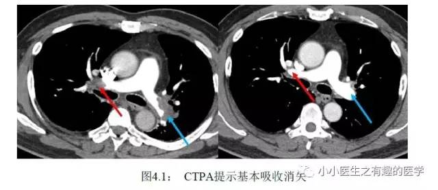 肺栓塞CT轻松入门