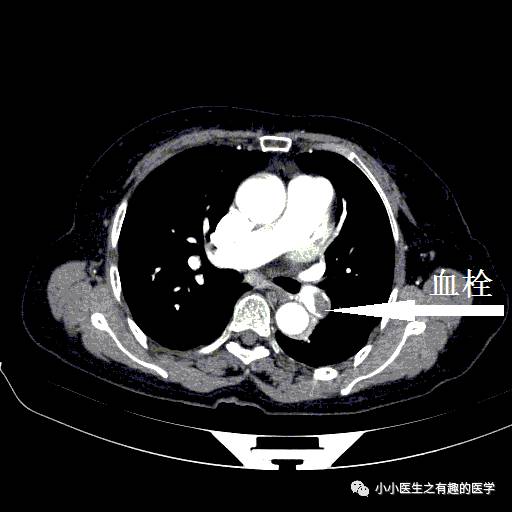 肺栓塞CT轻松入门
