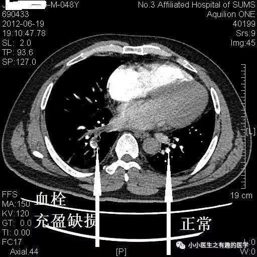 肺栓塞CT轻松入门