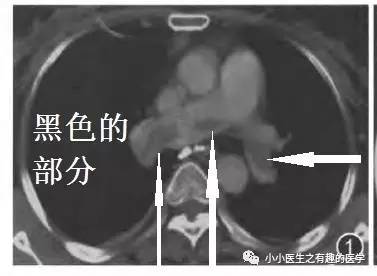 肺栓塞CT轻松入门