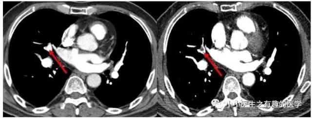 肺栓塞CT轻松入门