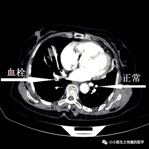 肺栓塞CT轻松入门